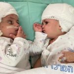 चिकित्सकले गरे टाउको जोडिएका जुम्ल्याहाको सफलतापूर्वक शल्यक्रिया